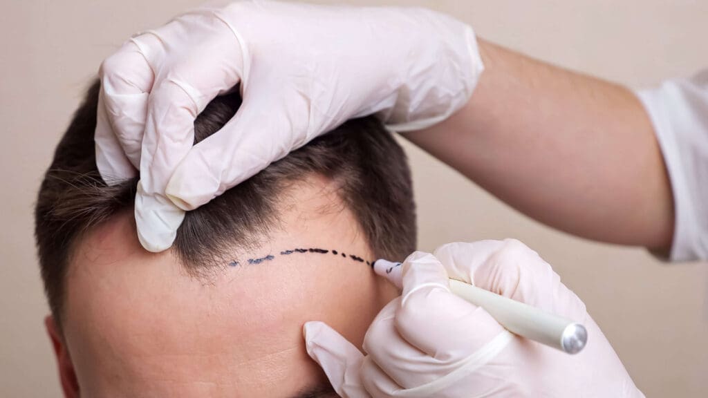 Hair Transplant Without Shaving in Turkey