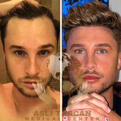 Hair Transplant in Turkey - Before & After - From USA