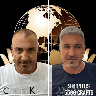 Hair Transplant in Turkey - Before & After - 5500 Grafts