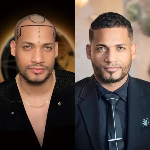 Hair Transplant in Turkey - Before & After - After 12 months