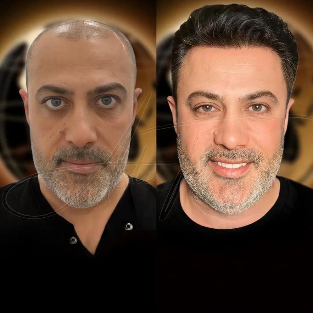 Hair Transplant in Turkey - Before & After - 10 months result