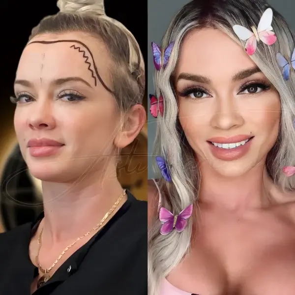 Hair Transplant in Turkey - Before & After - Women