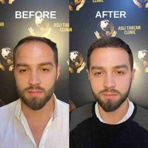 Early Receding Hairline - Before and After