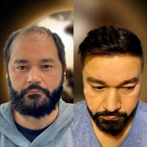 Example of a successful hair transplant