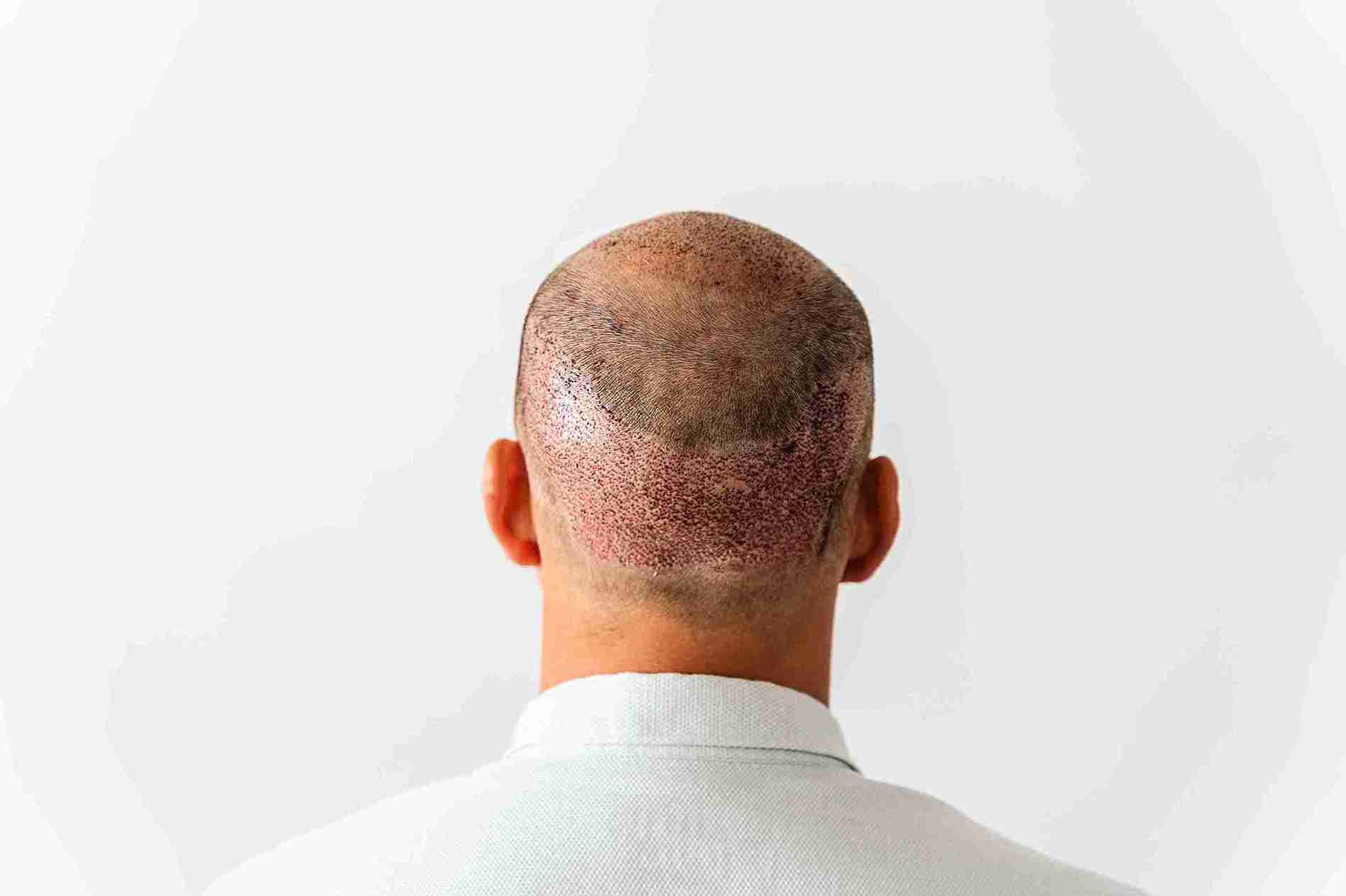 Haartransplantation Krusten