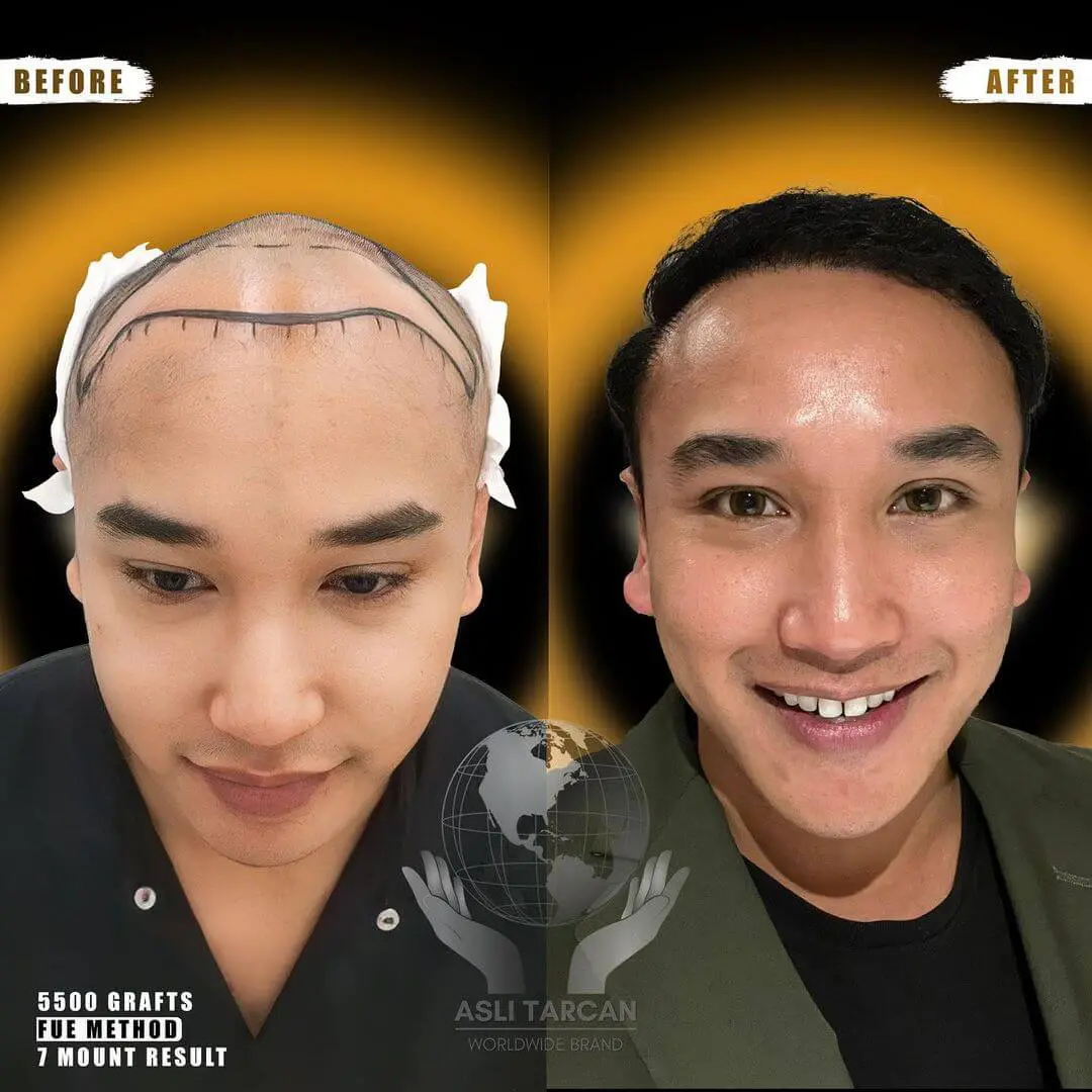 Trasplante capilar Turquía antes y después 5500 injertos