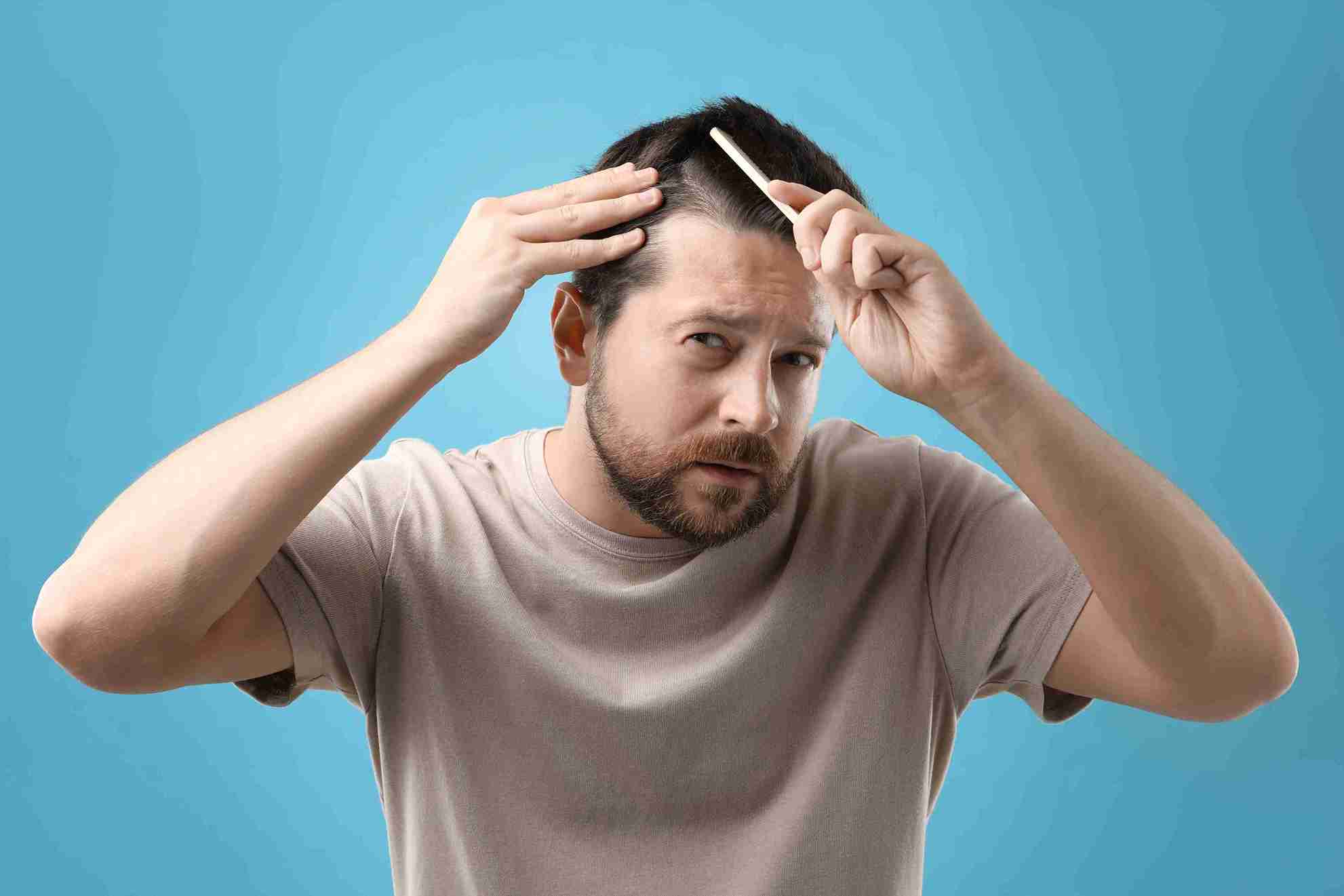 Hombre con pérdida de cabello, considerando un injerto capilar